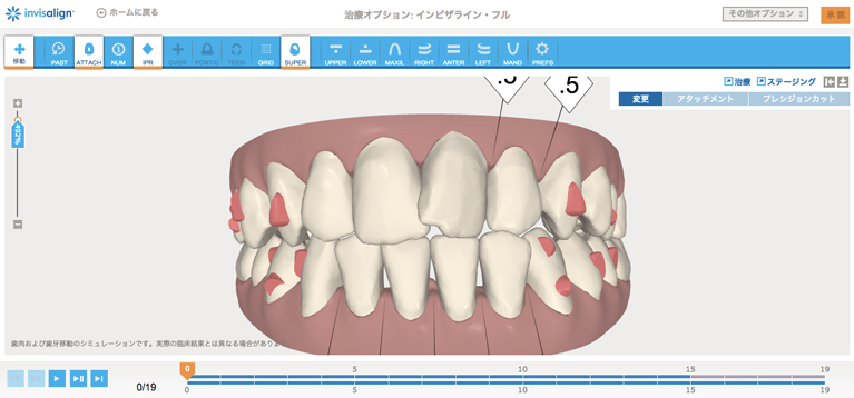 近年のマウスピース矯正について