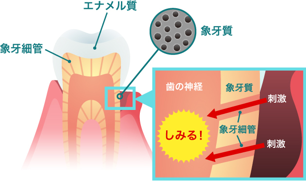 知覚過敏