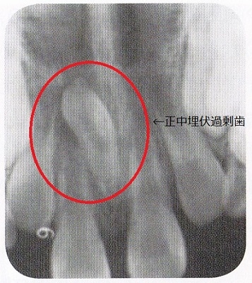 正中埋伏過剰歯