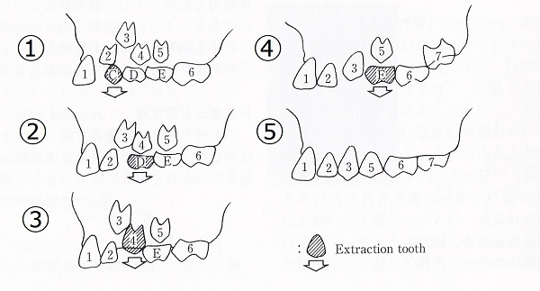 連続抜去法　歯科矯正学辞典より