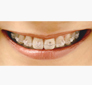 歯の表側からの矯正