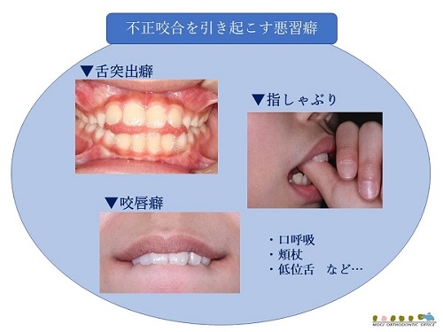 不正咬合を引き起こす悪習癖