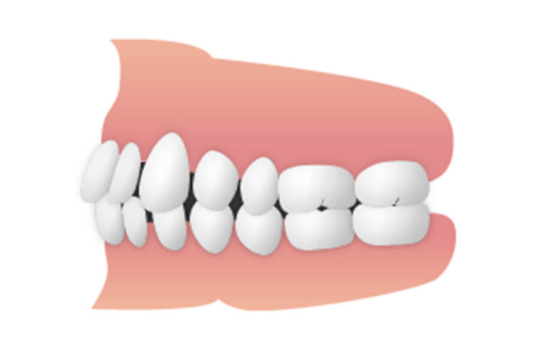 正中離開（せいちゅうりかい）／空隙歯列