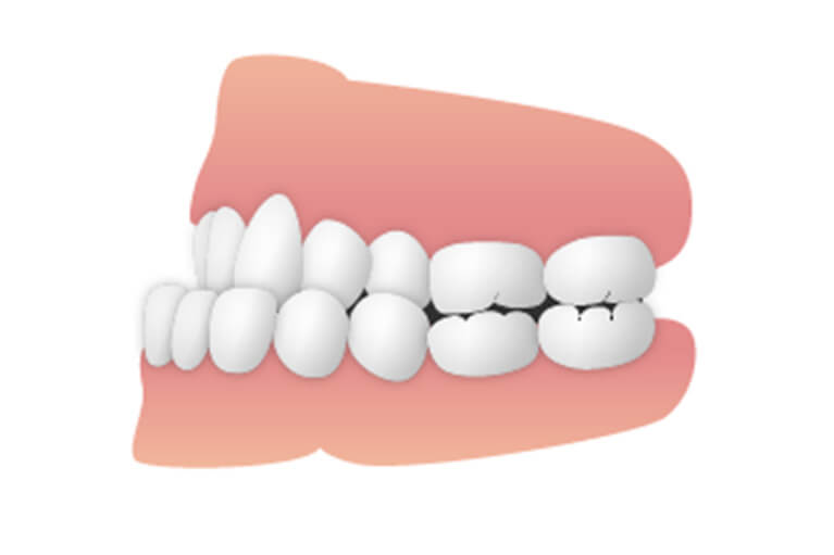 反対咬合（はんたいこうごう）／下顎前突（かがくぜんとつ）