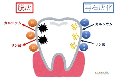 脱灰　再石灰化